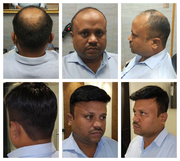 Hair Patch in Ambala-

Going bald can ha