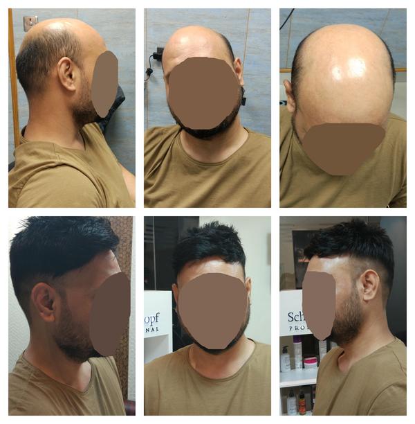 Hair Patch in Patiala-

Going bald can h