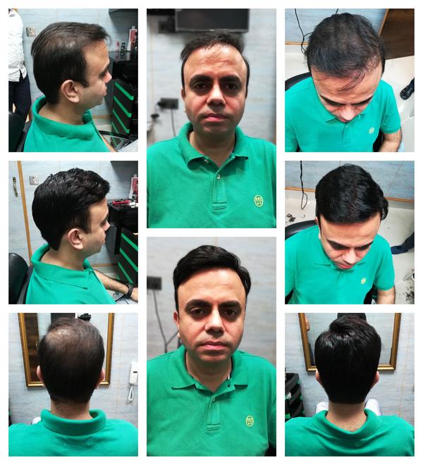 Hair Patch in Jalandhar-

Going bald can