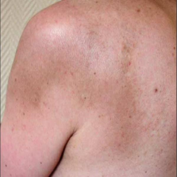 BEST TREATMENT FOR BACK PIGMENTATION IN 