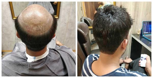 Hair Replacement in Udyog Vihar Delhi-

