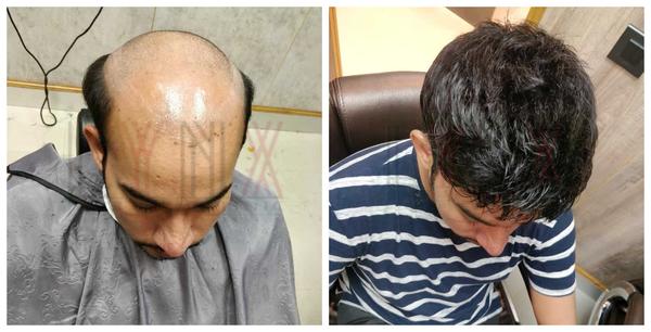 Hair Replacement in Nangloi Delhi-

Hair