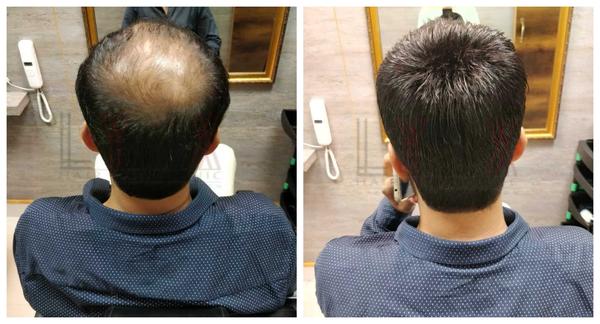 Hair Replacement in Manglapuri Delhi-

H