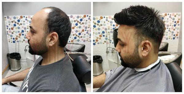 Hair Replacement in Shahdara Delhi-

Hai