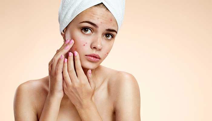 What is Acne?
    Acne is a skin conditi