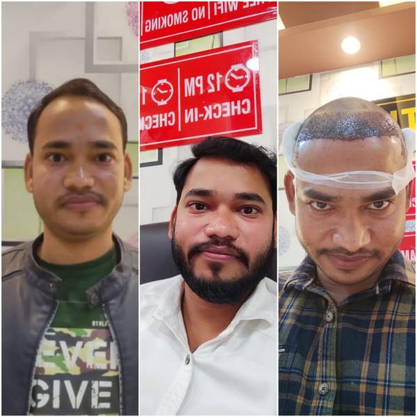 hairloss hairtransplantation