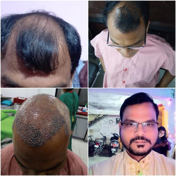 natural hairline