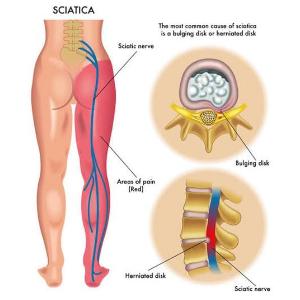 Can hijama cupping cure sciatica?


Scia