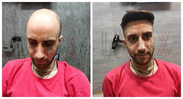 Hair Patch in Yelahanka-

Going bald can