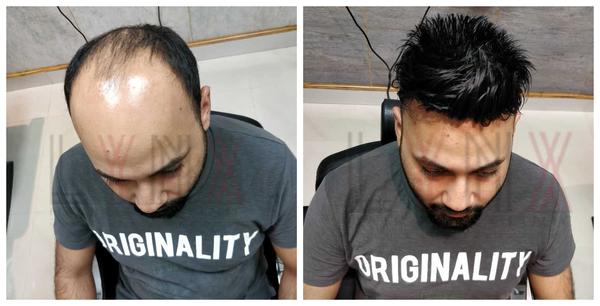 Hair Patch in Yeswanthpur-

Going bald c