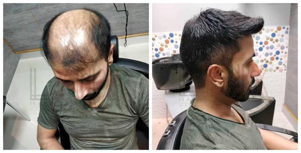 Hair Patch in Jayanagar-

Going bald can