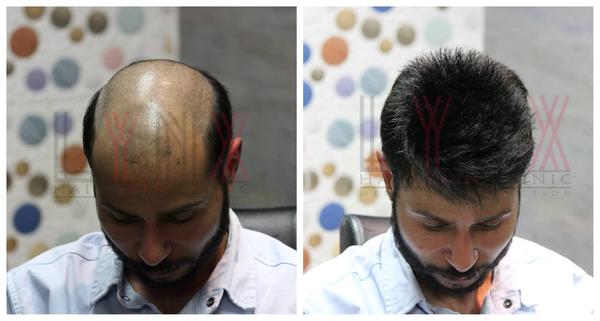 Hair Patch in Malleswaram-

Going bald c