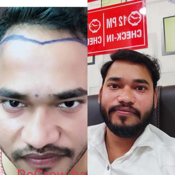 hairtransplantcost