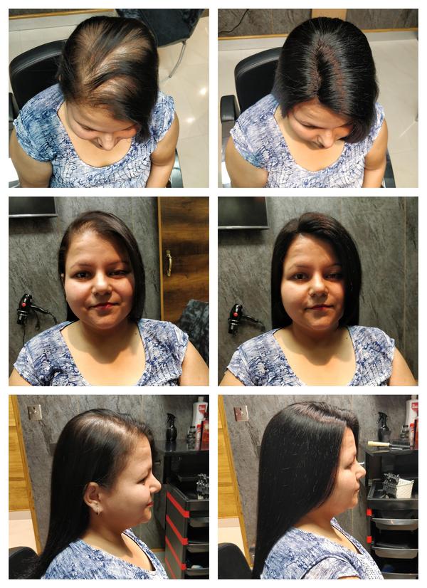 Hair Patch in Kothnur, Bangalore-

Going