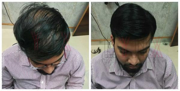 Hair Patch in Rajaji Nagar, Bangalore-

