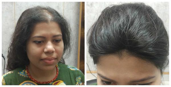 Hair Patch in Naagarabhaavi, Bangalore

