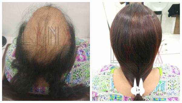 Hair Patch in Lalbagh, Bangalore-

Going