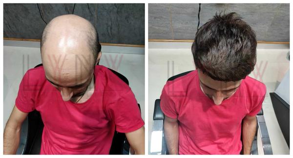 Hair Patch in Srirampura, Bangalore-

Go