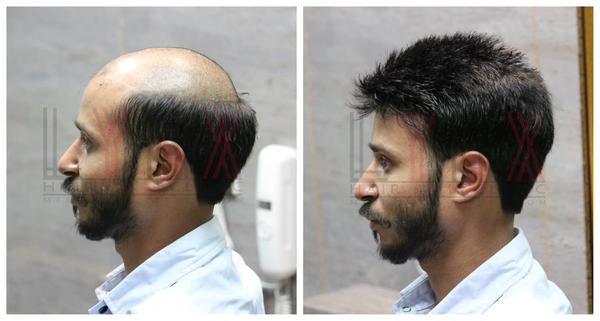 Hair patch in Visakhapatnam-

Hair patch
