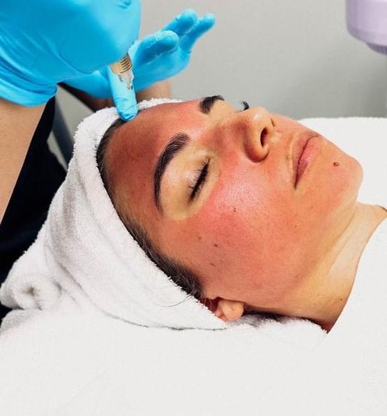 face prp treatment