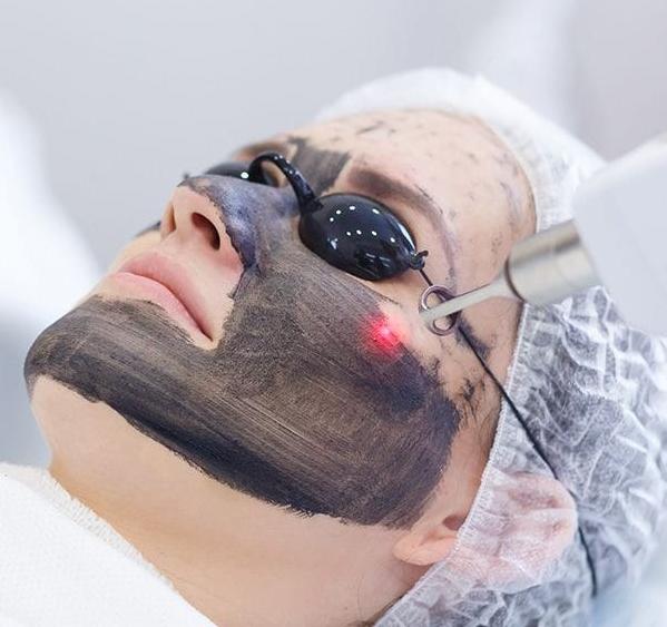 carbon laser facial descriptio
