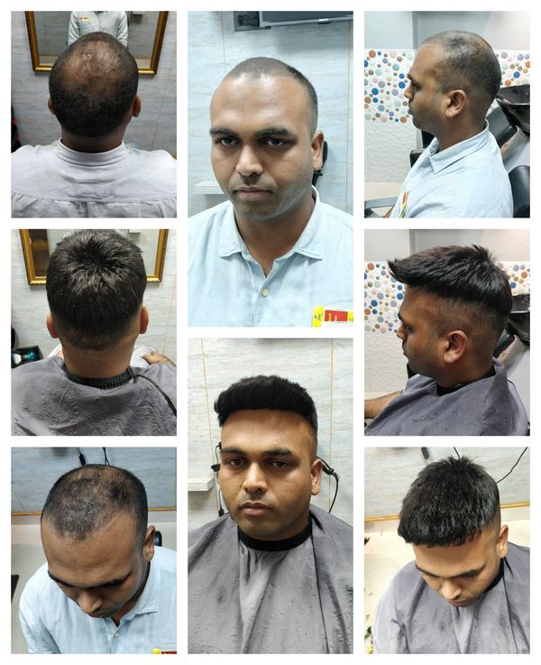Hair patch in Thillai Nagar, Trichy-

Ha