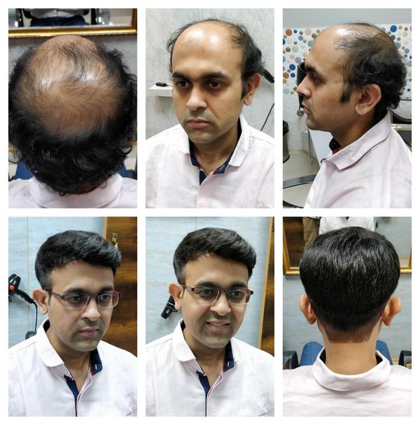 Hair patch in Ramanathapuram, Coimbatore