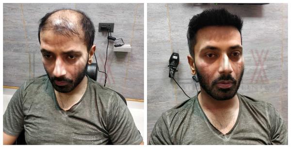 Hair patch in Dwaraka Nagar, Visakhapatn