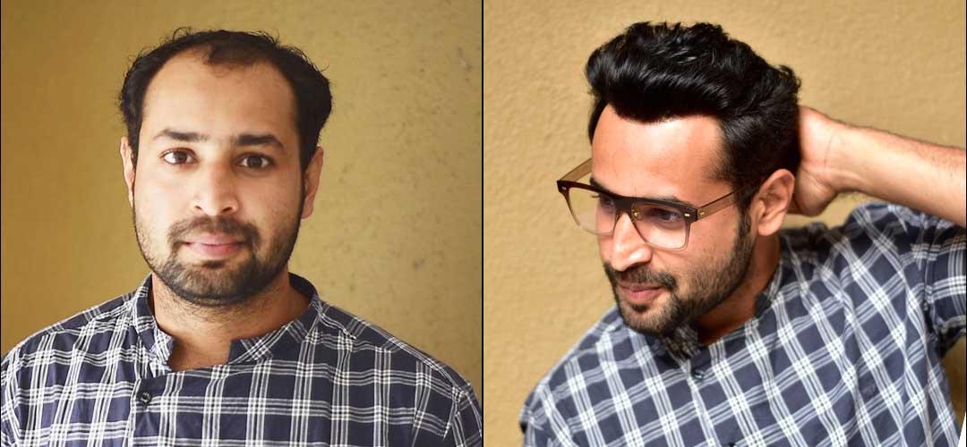 Non Surgical Hair Replacement
Systems Fo