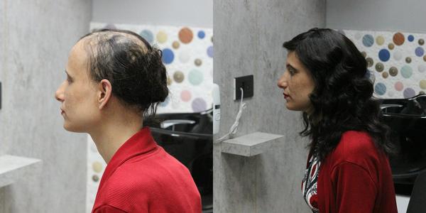 Chemo wigs procedure in Vizag-Visakhapat
