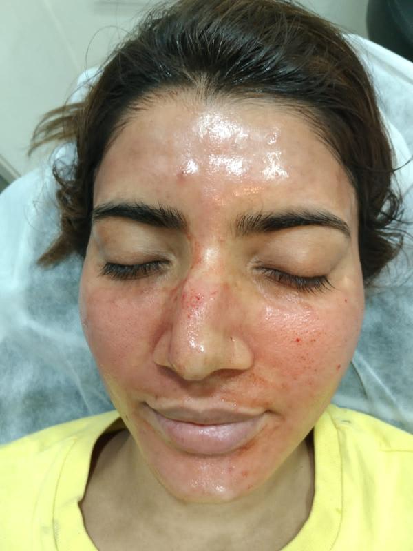 WHAT IS VAMPIRE FACIAL?
Vampire facial i