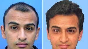 Benefits of Non-Surgical Hair Replacemen