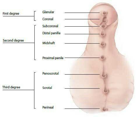 Hypospadias Overview Hypospadias Is A Birth Defect Sukhayu Hypospadias Overview Hypospadias Is A Birth Defect Sukhayu