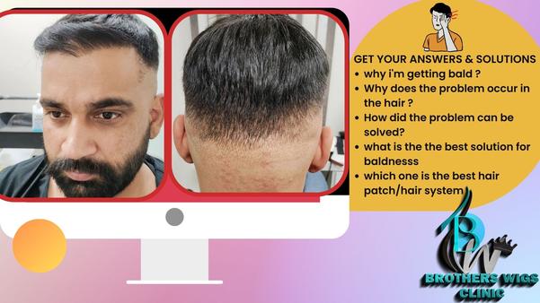hair patch solutions