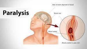 paralysis rehab treatment in p