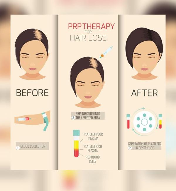 prp treatment experience