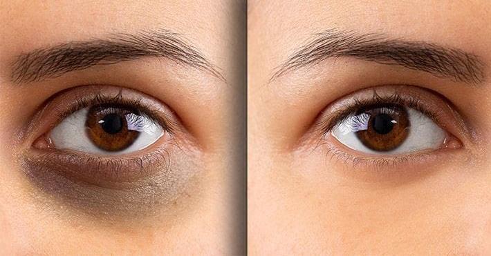 dark underarms treatment
