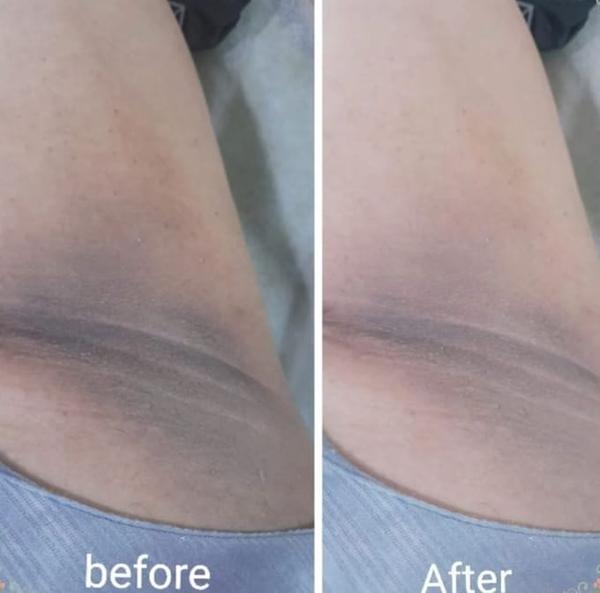 excessive sweating