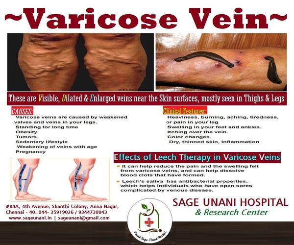 varicose veins