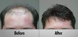 Hair is very important for hum