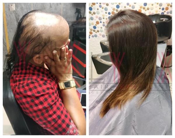 Hair Wigs in Secunderabad- 
Lynx Hair St