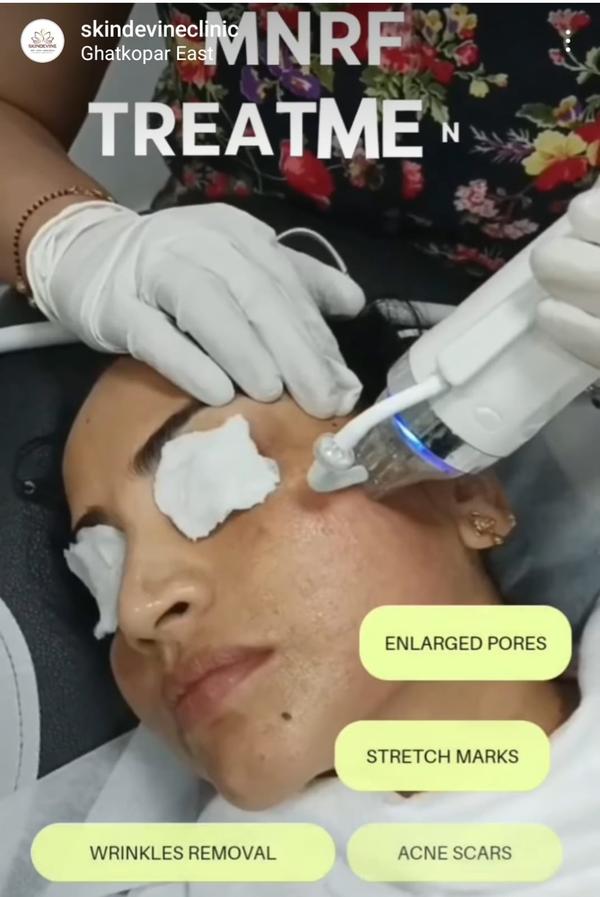 BEST TREATMENT FOR ACNE SCAR AND OPEN PO