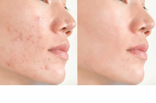wart removal in chennai withou