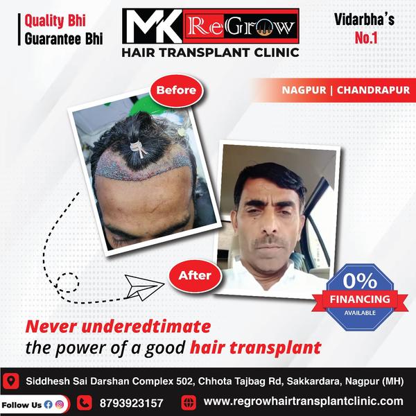 nagpur hair transplant mk