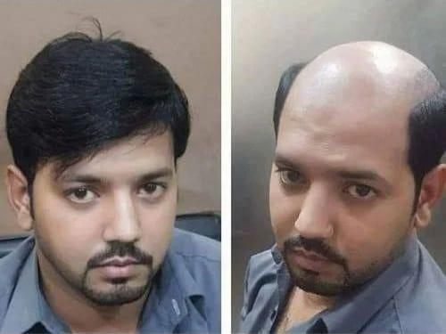 Hair patch in Hyderabad, Best
