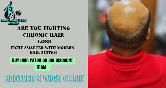 non surgical baldness treatmen