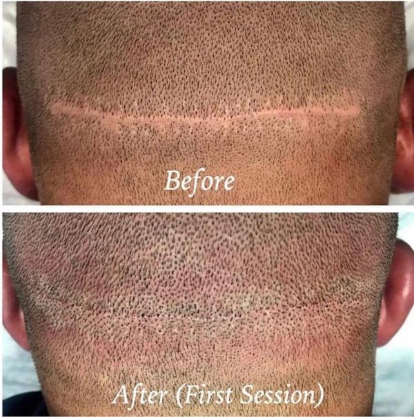 SMP (Scalp Micro pigmentation) Results 