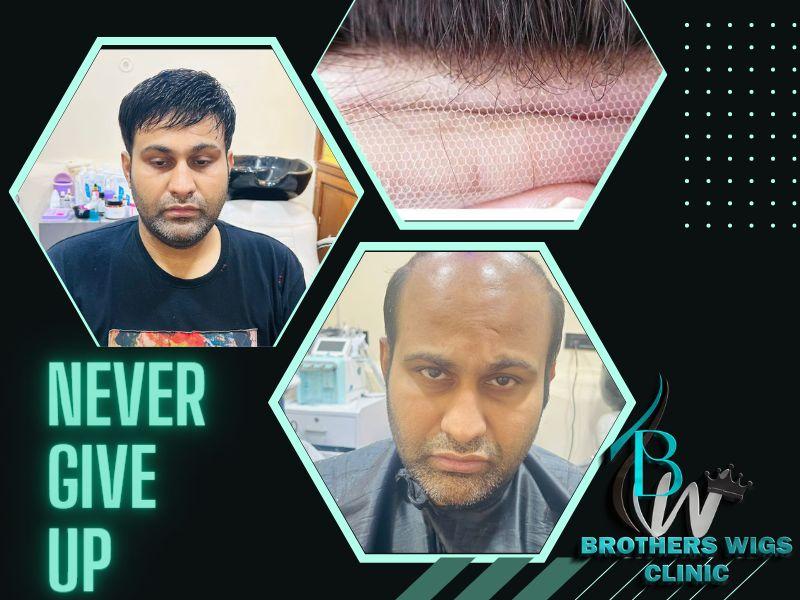 surgical hair replacement solu
