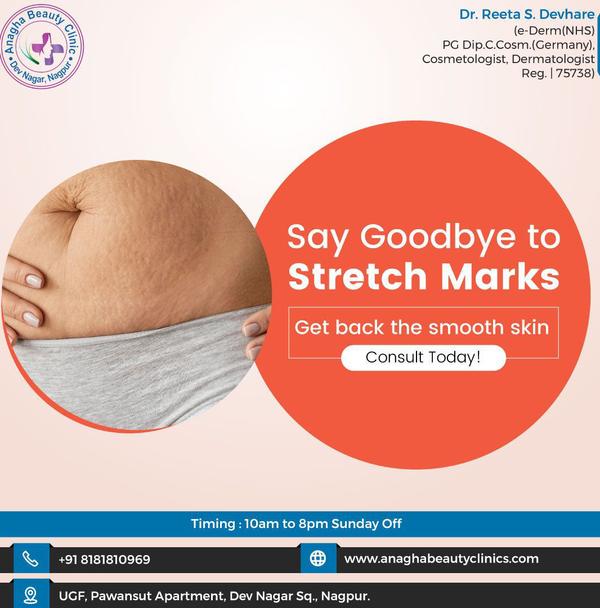 best treatment for stretch marks through
