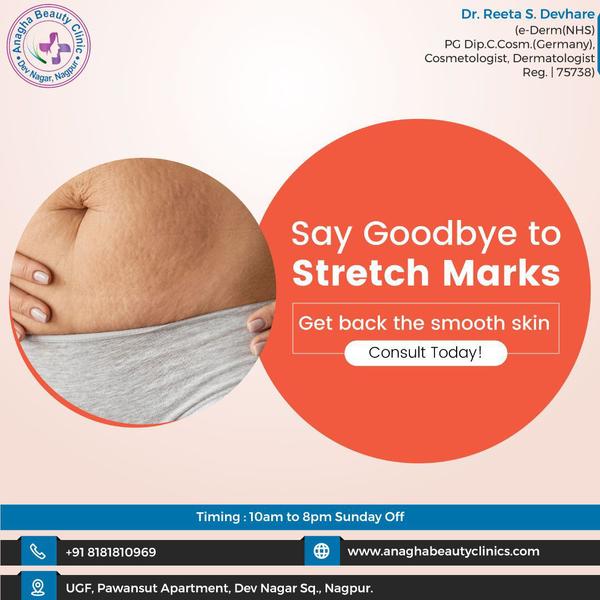 Say Goodbye To Stretch Marks !!!!!!
•
•
